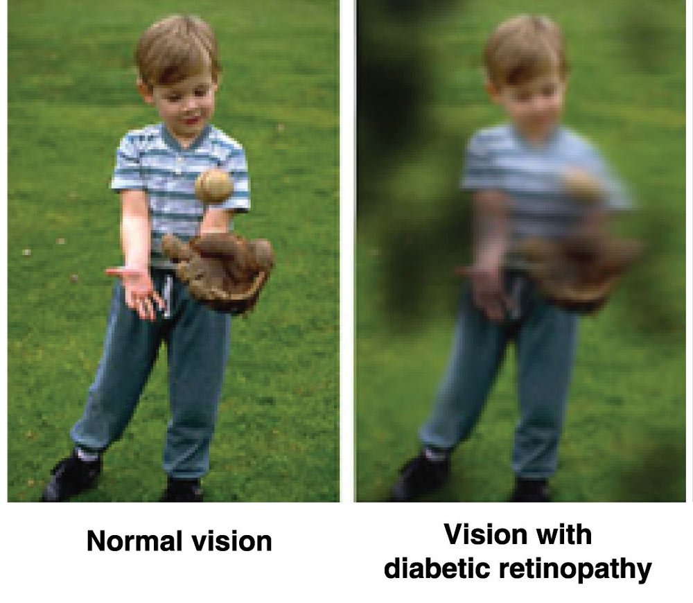 Image-1---Normal-Vision-and-Vision-with-diabetic-retinopathy Image-1---Normal-Vision-and-Vision-with-diabetic-retinopathy